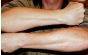 Smidge Spray 75ml test results on arm 